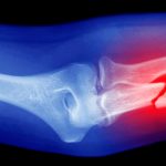 ایمپلنت حاوی نانوپوشش پلیمری برای رفع نقص استخوان آسیب‌دیده